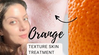 Treatment for textured skin I Oily Skincare I Treatment for large open pores and textured skin [upl. by Elleoj7]