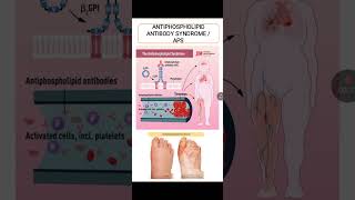 Antiphospholipid Antibody Syndrome [upl. by Luhar]