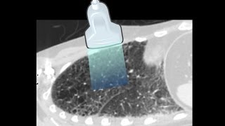 Lung Ultrasound  Interpretation Tutorial [upl. by Annaehr]