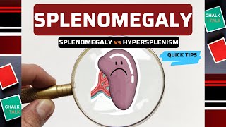 SPLENOMEGALY ENLARGEMENT OF THE SPLEEN [upl. by Eceinhoj]