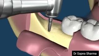 How a Dentist Removes Wisdom Tooth  Impacted Wisdom Tooth Removal Procedure [upl. by Jeromy]