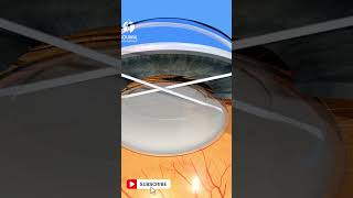 Cataract Explained  Everything you need to know [upl. by Sesylu]