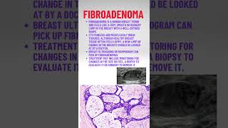 Fibroadenoma pathologyacademy draditikumar mbbs neet neetpg [upl. by Darrin]