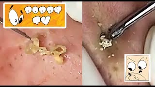 Large Closed Comedones  Whiteheads Extraction [upl. by Weiner424]