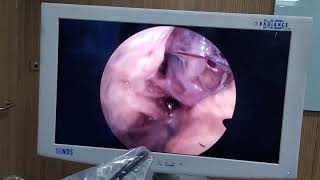 Endoscopic Transorbital Approach [upl. by North]