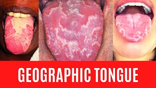 GEOGRAPHIC TONGUE  Benign Migratory Glossitis  Erythema Areata Migrans What is Geographic Tongue [upl. by Wartow924]