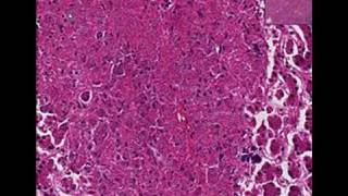 Histopathology Liver Histoplasmosis [upl. by Oile]