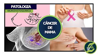 Câncer de Mama Patologia Imunohistoquímica e assinaturas gênicas [upl. by Coniah]