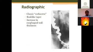 Why Cant I Swallow The Science Behind Dysphagia [upl. by Scotney]