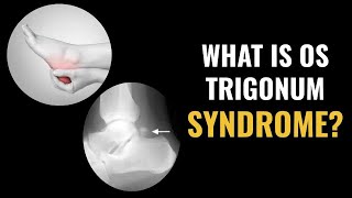 What is Os Trigonum Syndrome [upl. by Ahserb]