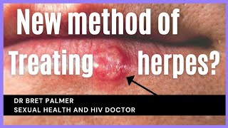 Possible new treatment for herpes [upl. by Eelytsirk]