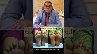 Psoriasis on Feet Soles Homeopathy Treatment Before amp After Results [upl. by Ardnaxila]