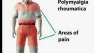 Polymyalgia rheumatica lecture [upl. by Jet]