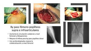 Arteriopatía Periférica [upl. by Campman]