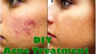 DIY Acne Treatment  It Works How to Get Rid of Acne [upl. by Theresita]