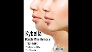 Kybella Double Chin Removal Treatment By Dr Shukla l ShineMD MedSpa amp Liposuction Center [upl. by Moffitt]