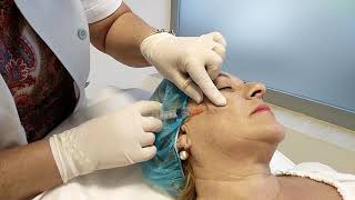 Mesoterapia facial a través de cánula sin marcas Central Clinic Sevilla [upl. by Lachman]