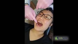 How To Replace an Orthodontic Separator [upl. by Holleran]