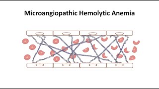 Microangiopathic Hemolytic Anemia [upl. by Schuman]