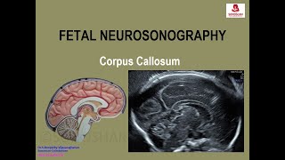 Fetal Neurosonography – Corpus Callosum [upl. by Sachi366]