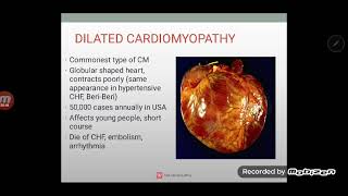 Cardiomyopathy amp Myocarditis [upl. by Evelinn]