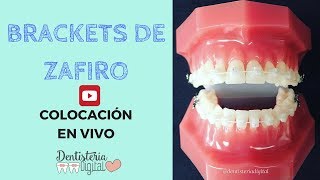 Colocación de brackets de Zafiro EN VIVO [upl. by Marpet64]