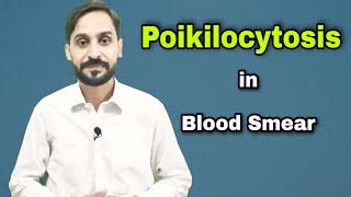 Poikilocytosis  Types of Poikilocytosis  4th Video  Blood Smear Series [upl. by Ayekram309]