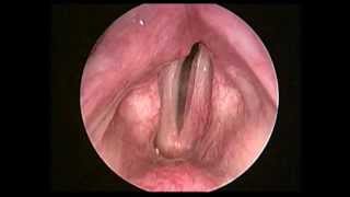 左側聲帶麻痺術前left vocal fold paralysis preop [upl. by Siuoleoj210]