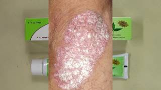 REVIEW Sorion Natural Moisturizing Cream  Psoriasis Skin Care with Coconut Oil and Neem [upl. by Annalise973]