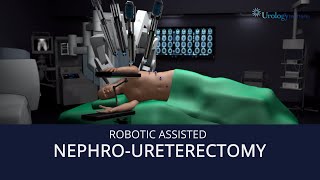 Robot Assisted NephroUreterectomy [upl. by Abell109]