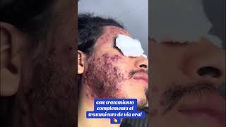 ACNE SEVERE ROACCUTANE TRAITEMENTS DERMATOLOGUE  EXTRACTION acne acnetreatment santé boutons [upl. by Ogires789]