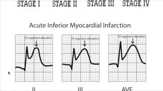 Myocardial Infarction Vs Ac Pericarditis amp Dressler syndrome [upl. by Carisa]