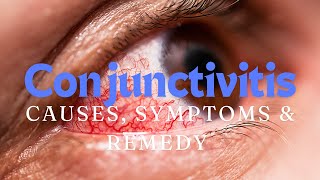 Understanding Conjunctivitis Causes Symptoms and Remedy [upl. by Julian]