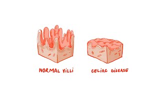 These Foods May Cause Leaky Gut [upl. by Aneis682]