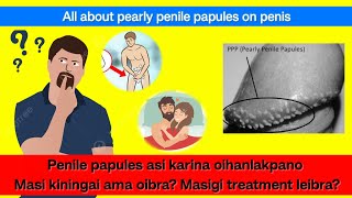 What is Pearly Penile Papules  Masi kiningai ama oibra  Masigi treatment ga leibra [upl. by Hilario19]