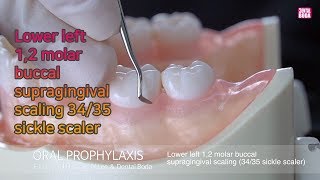 Lower left 12 molar buccalsupragingival scaling 3435 sickle scaler [upl. by Alded]