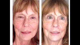 Microcurrent Facelift and the eyes what you can expect after a series of treatments [upl. by Delisle844]