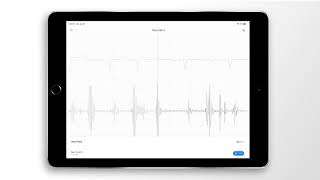 Atrial Fibrillation Combined Heart Sound PCG amp ECG Example  EkoCLINIC App [upl. by Arramat]