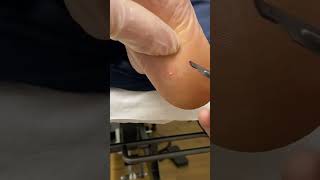 Expert Australian Podiatrist Removes Painful Corns with Precision [upl. by Therine43]