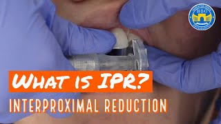 Interproximal Reduction IPR on Teeth for Braces and Invisalign [upl. by Denie]