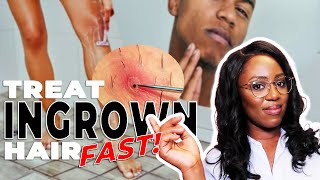 How to Remove Ingrown Hairs and Razor Bumps  This ACTUALLY works [upl. by Eittol]