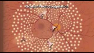 Pan Retinal Photocoagulation Diabetic Retinopathy [upl. by Soo]