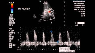 Normal Renal Artery Flow  Case Study [upl. by Inavihs314]