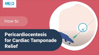 How to Pericardiocentesis for Cardiac Tamponade Relief [upl. by Annairba687]