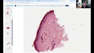 Avi Bitterman Dermpath Lecture 10 Genoderms [upl. by Latreece]