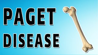 Pagets Disease [upl. by Simsar]