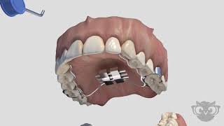 Palatal Expander [upl. by Luis]