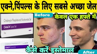 clinbidn gel review in hindi  clindamycin phosphate and nicotinamide gel how to use [upl. by Nezah]