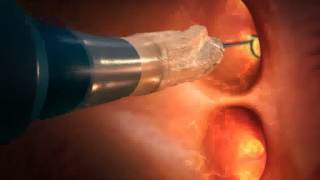 How Cryoballoon ablation works [upl. by Aicilet]