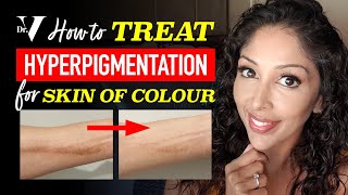 DOCTOR Vs HOW TO TREAT HYPERPIGMENTATION for SKIN OF COLOUR  BROWN DARK SKINCARE  DR V soc [upl. by Merlina]